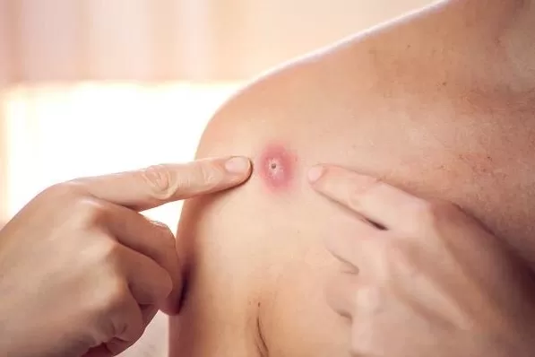 مدار الساعة,أخبار عربية ودولية,جدري القردة