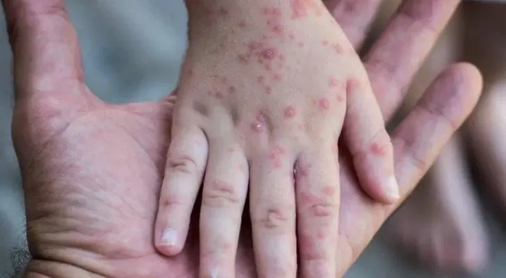 مدار الساعة,أخبار عربية ودولية,جدري القردة,رئيس الوزراء