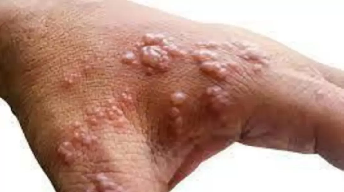 مدار الساعة,أخبار عربية ودولية,جدري القردة,منظمة الصحة العالمية