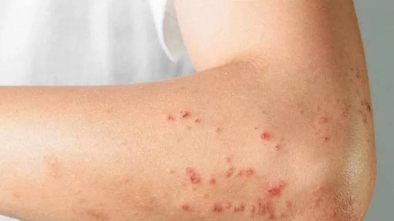 مدار الساعة,أخبار عربية ودولية,جدري القردة,وزارة الصحة