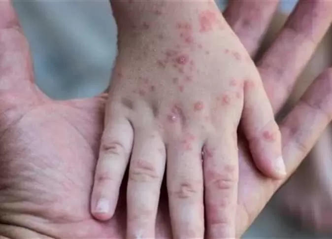 مدار الساعة,أخبار عربية ودولية,جدري القردة,وزارة الصحة