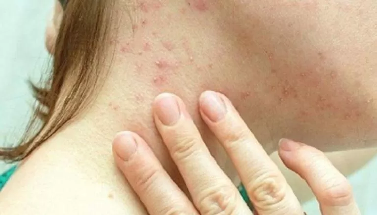 مدار الساعة,أخبار عربية ودولية,كورونا,جدري القردة,منظمة الصحة العالمية