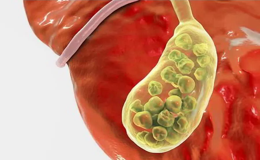 مدار الساعة,أخبار الصحة والأسرة,#متلازمة_ما_بعد_استئصال_المرارة #عملية_استئصال_المرارة #الأعراض_التي_تنتج_عن_استئصال_المرارة #العلاجات_لمتلازمة_ما_بعد_استئصال_المرارة #الأسباب_المحتملة_لمتلازمة_ما_بعد_استئصال_المرارة