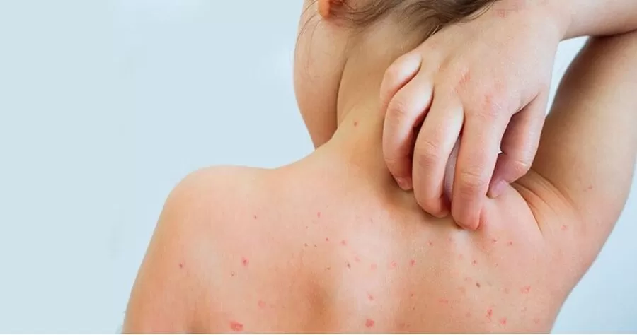 مدار الساعة,أخبار الأردن,اخبار الاردن,وزارة الصحة,#الحصبة #التطعيم #فريق_التتبع_الصحي