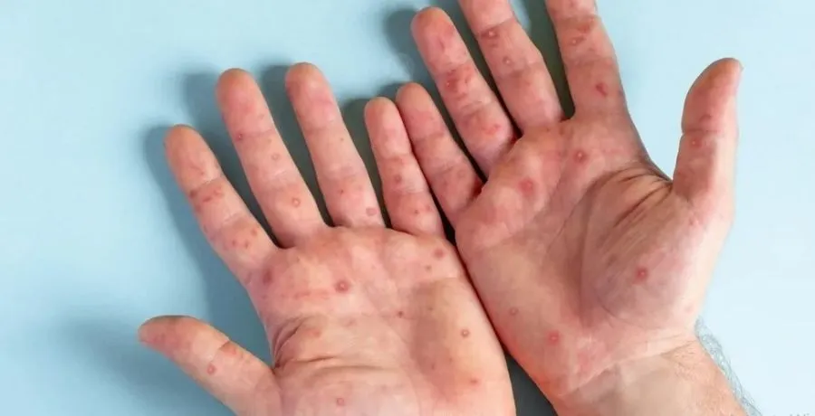 مدار الساعة,أخبار الأردن,اخبار الاردن,جدري القردة,المركز الوطني لمكافحة الأوبئة,وزارة الصحة