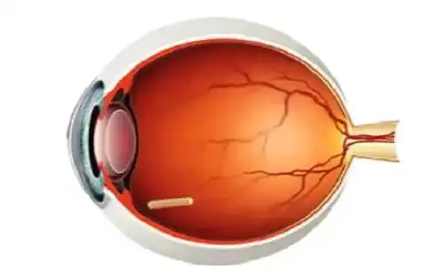 علاج جراحي جديد يقي العيون من