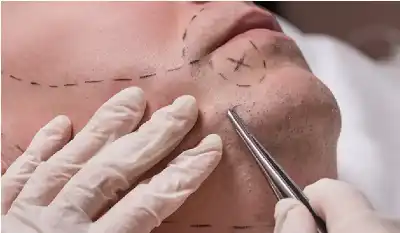 حكم استخدام مواد لاستنبات اللحية، وهل
