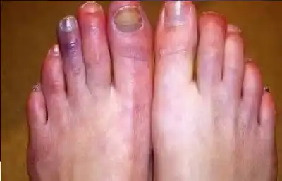 برودة اليدين والقدمين: متى يجب استشارة