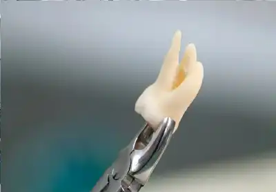 الخلع والتأثير على مخارج الحروف: الفتوى