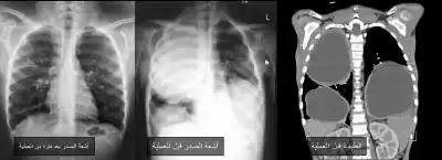 جراحة نوعية لاستئصال أكياس كلابية من