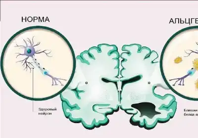 دراسة أمريكية: تراكم البروتينات في أوعية