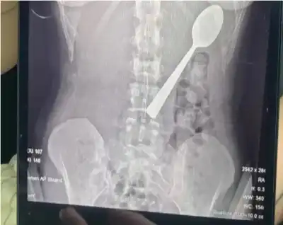 بسبب قفزة كلب.. بلجيكية تبتلع ملعقة