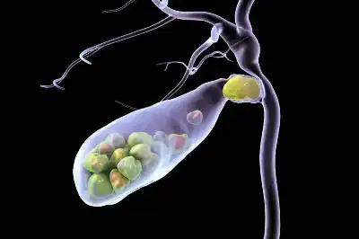 إليك طرق تكون حصى المرارة وطرق