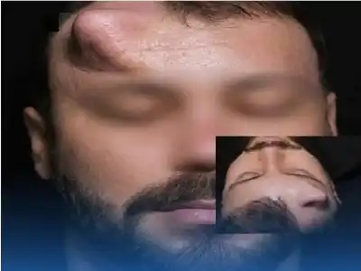 جراحة ترميمية معقدة.. زراعة أنف مؤقتة