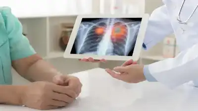 لماذا يصاب غير المدخنين بسرطان الرئة؟